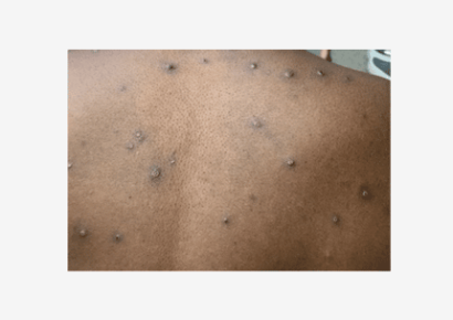 First Case of Monkeypox Virus reported in Alabama